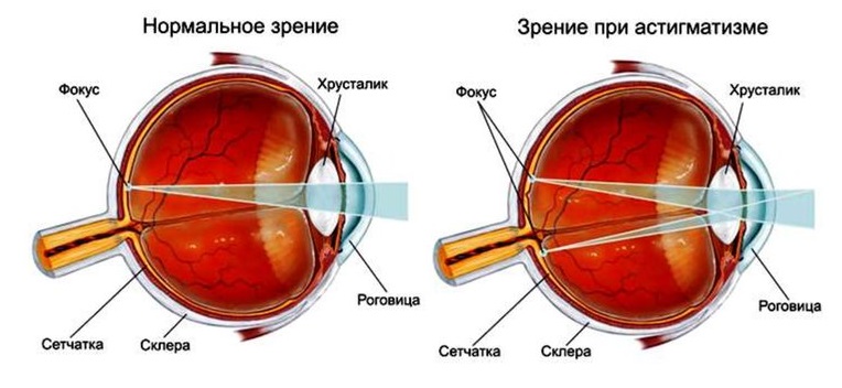Что такое сложный миопический астигматизм. Эмметропия. Виды аметропии глаза. Аметропия глаза. Разновидности аметропии.